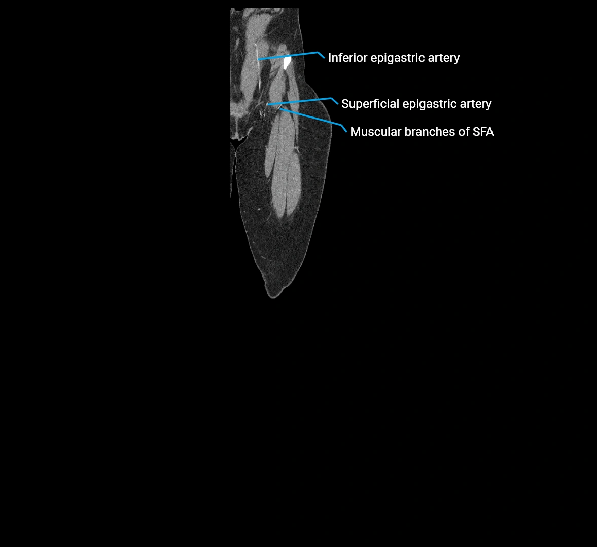 CTA lower limb coronal cross sectional anatomy labelled image _9 (1).webp